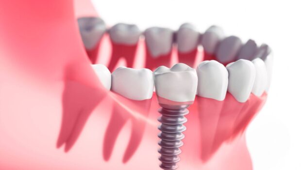 implant dentar Brasov